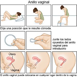 Anillo vaginal