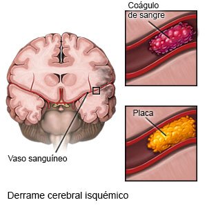 Derrame cerebral isquémico