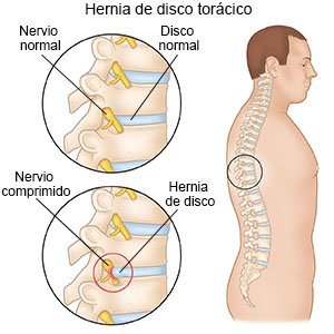 Hernia De Disco Torácico Care Guide Information En Espanol