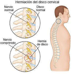 Herniación del disco cervical