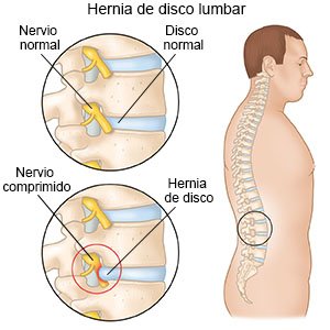 Hernia de disco lumbar