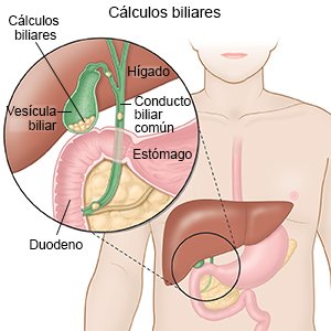 Cálculos biliares