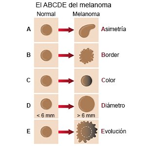 El ABCDE del melanoma