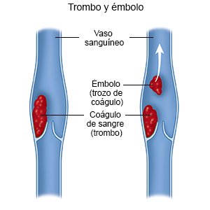 Trombo y émbolo