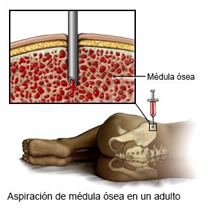 Aspiración de médula ósea