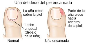 Uña del dedo del pie encarnada