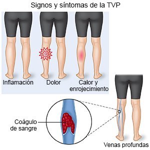 Signos y síntomas de la TVP