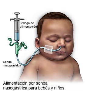 Alimentación con sonda nasogástrica (lactante)