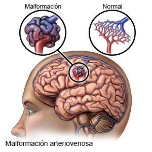 Malformación arteriovenosa