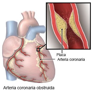 Arteria coronaria obstruida