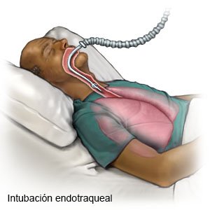 Tubo Endotraqueal