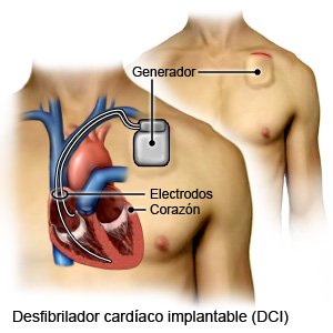 Desfibrilador cardíaco implantable (DCI)