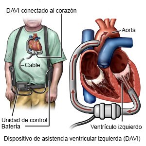 Dispositivo de asistencia ventricular izquierda (DAVI)
