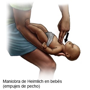 Maniobra de Heimlich en bebés (empujes de pecho)