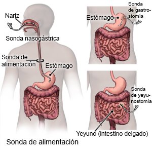 Sonda de alimentación