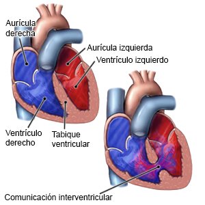 Comunicación interventricular