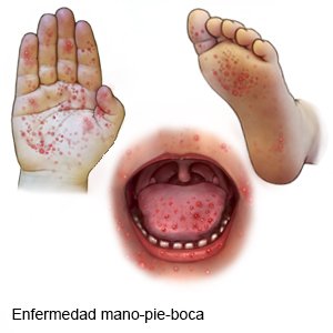 Enfermedad de manos, pies y boca