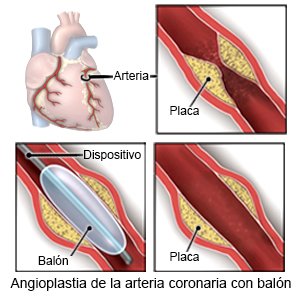 Angioplastia de la arteria coronaria (balón)