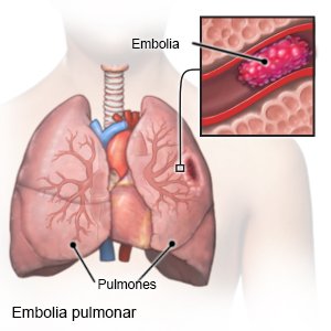 Embolia Pulmonar (Aftercare Instructions) Care Guide Information En Espanol