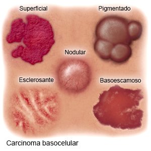 Carcinoma basocelular