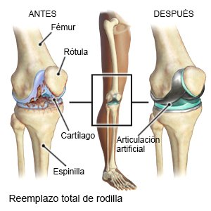 Reemplazo total de rodilla