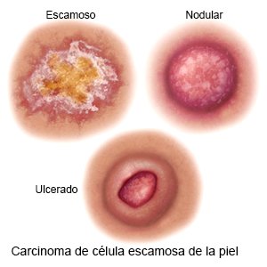 Carcinoma de célula escamosa de la piel