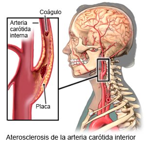 Aterosclerosis de la arteria carótida interior