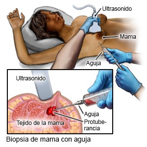 Biopsia de mama con aguja