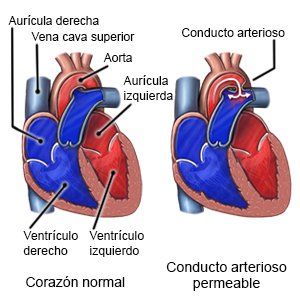 Conducto arterioso permeable