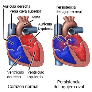 Persistencia del agujero oval