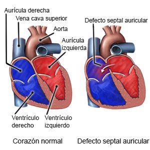 Defecto septal auricular