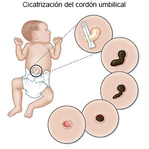 Cicatrización del cordón umbilical