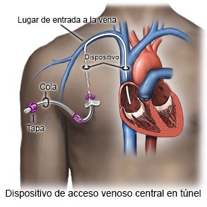 Dispositivo de acceso venoso central en túnel