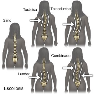 La escoliosis