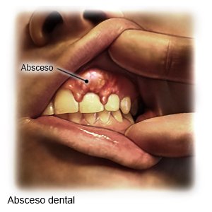 Absceso dental