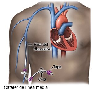 Catéter de línea media
