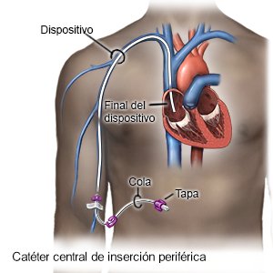 Catéter central de inserción periférica