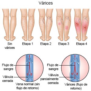 Várices