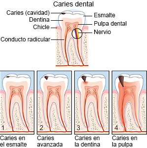 Caries dental
