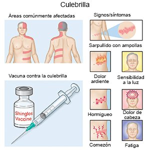 La culebrilla