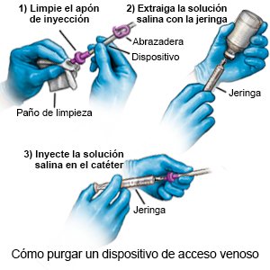 Cómo purgar un dispositivo de acceso venoso