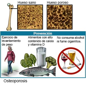 Osteoporosis