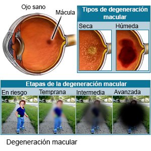 Degeneración macular