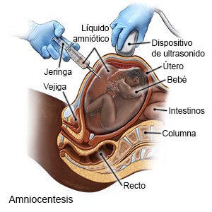 Amniocentesis