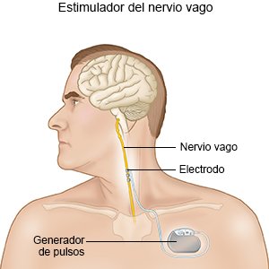 Estimulador del nervio vago