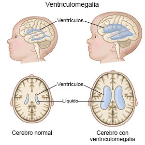 La ventriculomegalia