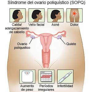 Síndrome del ovario poliquístico (SOPQ)