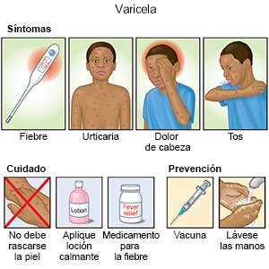 La varicela