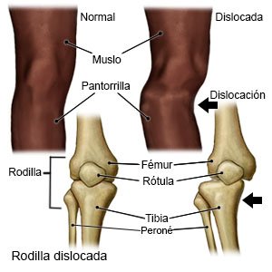 Dislocación De La Rodilla Care Guide Information En Espanol