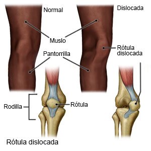 Rótula dislocada